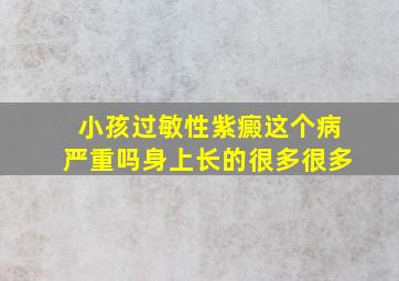 小孩过敏性紫癜这个病严重吗身上长的很多很多