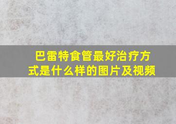 巴雷特食管最好治疗方式是什么样的图片及视频