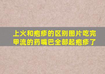 上火和疱疹的区别图片吃完甲流的药嘴巴全部起疱疹了