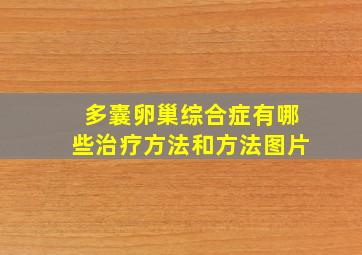 多囊卵巢综合症有哪些治疗方法和方法图片